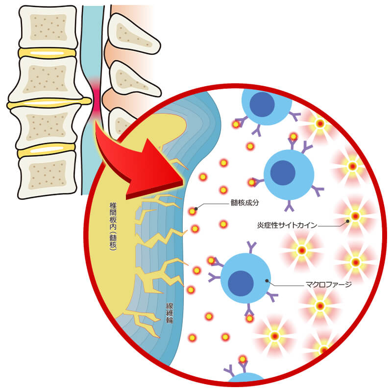 椎間板物質の漏出による炎症の概念図