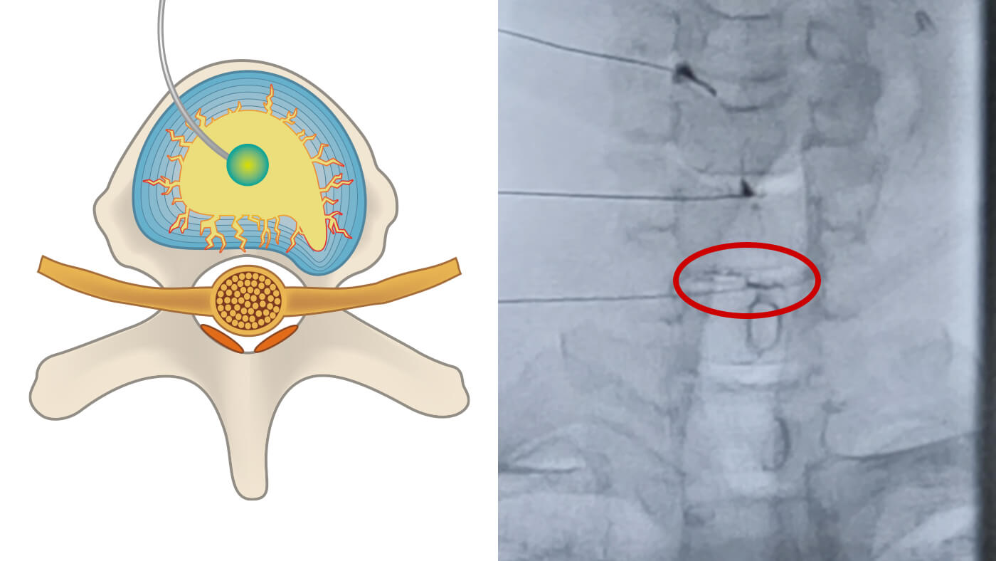 治療薬の注入の図解
