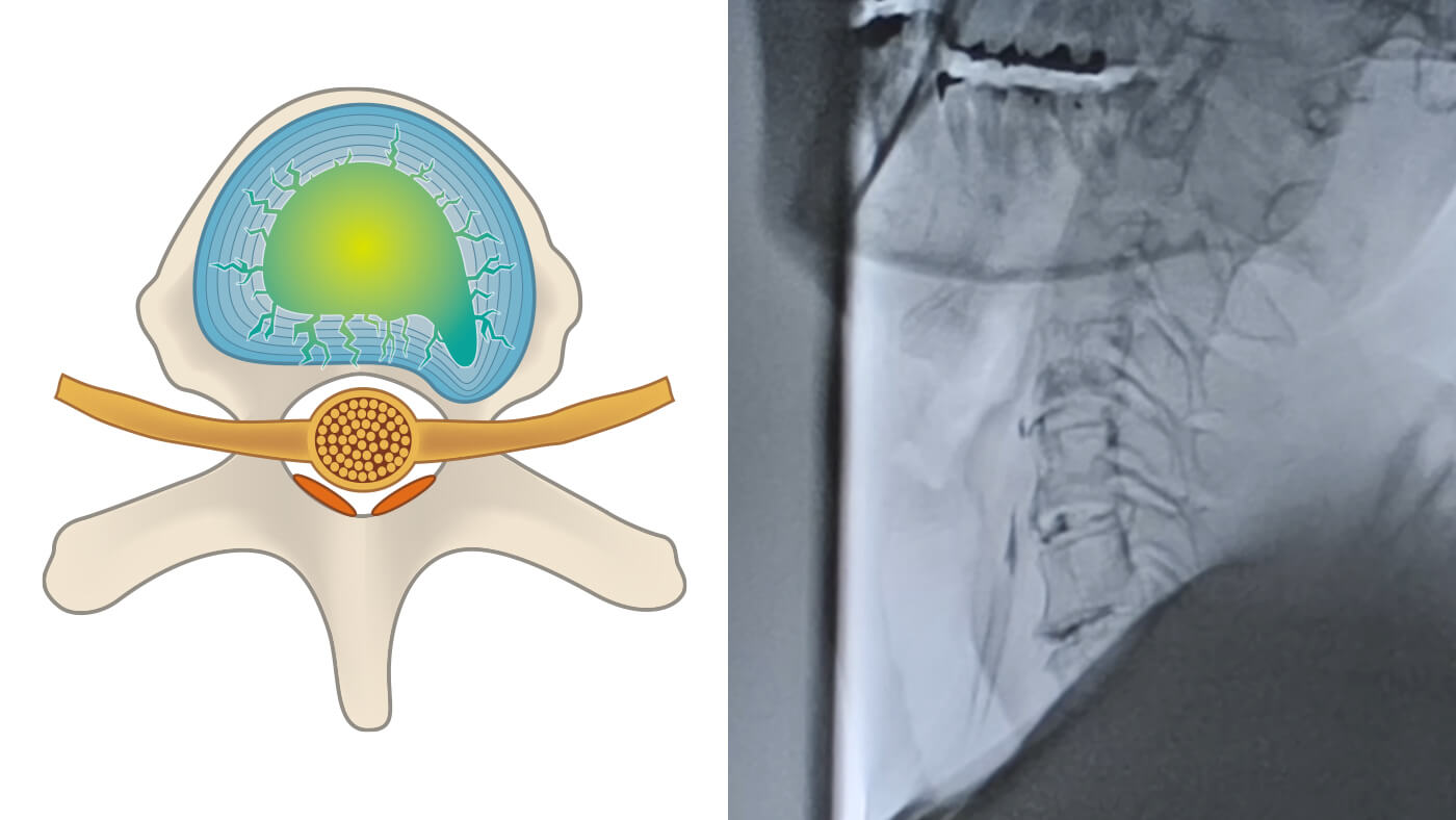 亀裂の密封と修復の図解